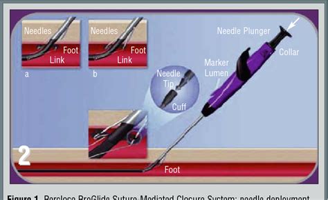 manual compression test quizlet|Femoral Vascular Closure Devices After Catheterization Procedure.